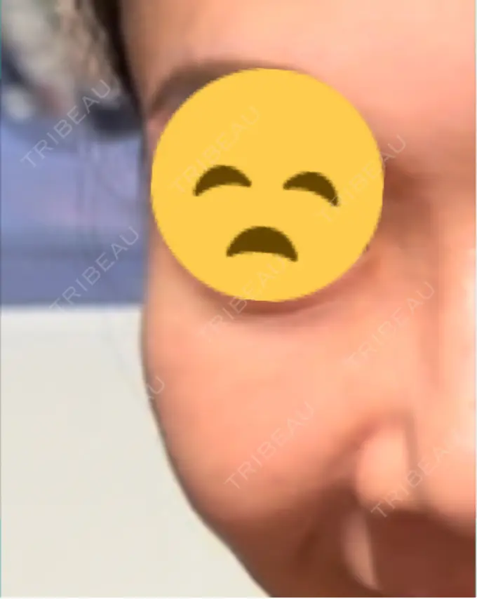 脂肪溶解注射（顔） MKクリニック 銀座院 BEFORE メイン用