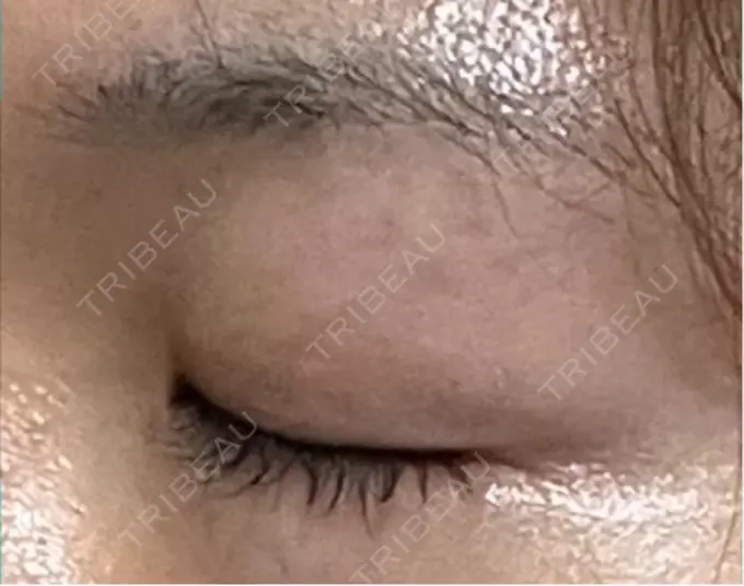 上まぶたの脂肪取り / 眉下切開 / ボトックス（眉間） THE FIRST CLINIC 多摩センター院 BEFORE メイン用