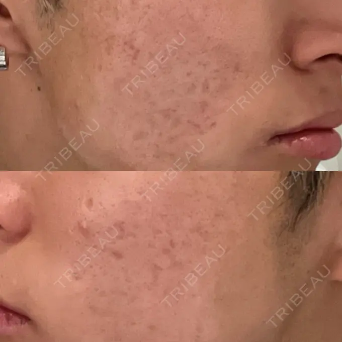 肌ヒアルロン酸注入（たるみ・シワ改善） / その他（肌） / ニキビ治療 ゆきスキンクリニック 東池袋 BEFORE メイン用