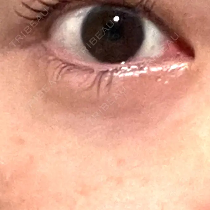 ボトックス（タレ目） MKクリニック 銀座院 BEFORE メイン用