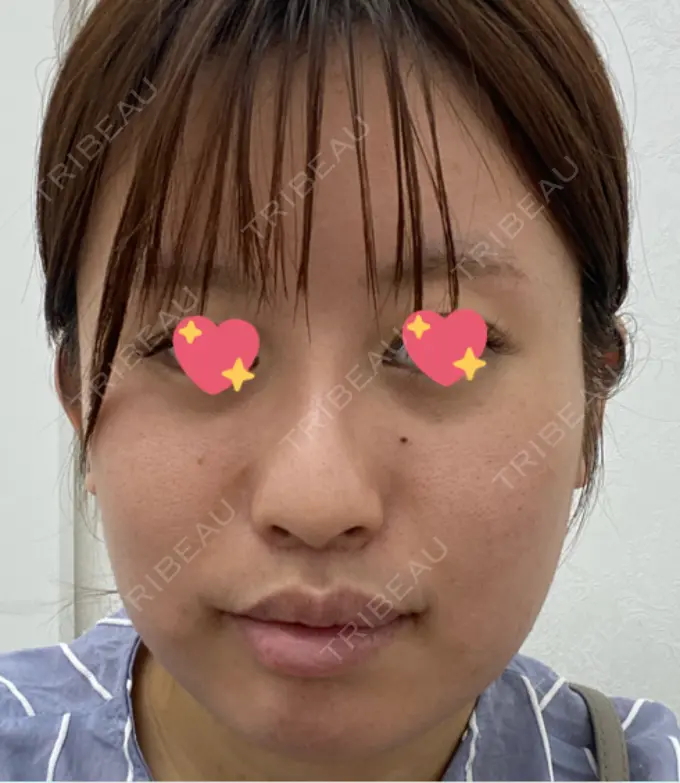 ほくろ・いぼ切除（肌） TCB東京中央美容外科 新潟院 BEFORE メイン用