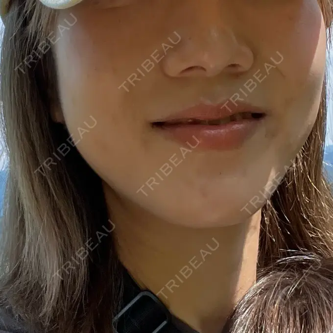 美容点滴・美容注射（美肌） / レーザートーニング（美白・肝斑） 城本クリニック 立川院 BEFORE メイン用