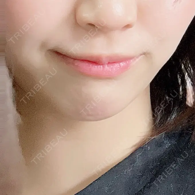 ボトックス（あご） / ヒアルロン酸注入（あご） 新宿TAクリニック BEFORE メイン用