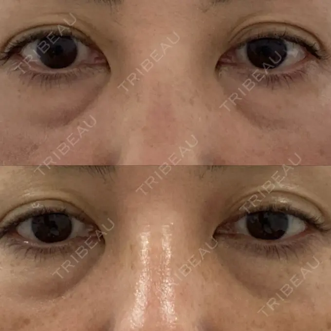 クマ治療 / 下まぶたたるみ取り / ヒアルロン酸注入（目の下） / ボトックス（目尻） TCB東京中央美容外科 神戸院 BEFORE メイン用