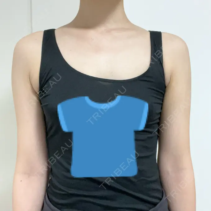 脂肪吸引（二の腕） 4Dクリニック BEFORE メイン用