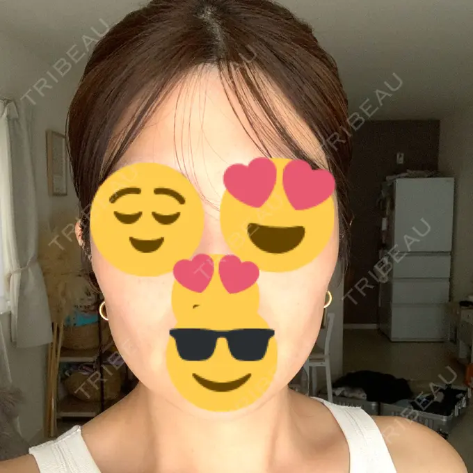 ボトックス（エラ・小顔） / エレクトロポレーション / 光治療（フォトフェイシャルなど） / ピーリング（ハリ・ツヤ） ミニマムスキンクリニック池袋 BEFORE メイン用