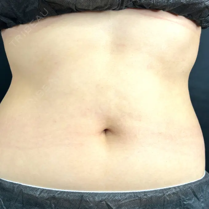 へそ形成 藤・ナチュレ美容クリニック 銀座院 BEFORE メイン用