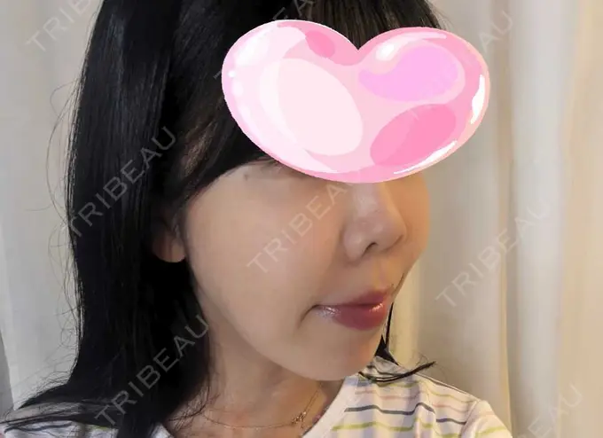 プロテーゼ除去 / 鼻翼基部形成（貴族手術） / 鼻尖形成（非切開） / 鼻中隔延長（非切開） ジョウクリニック 大阪院 BEFORE メイン用