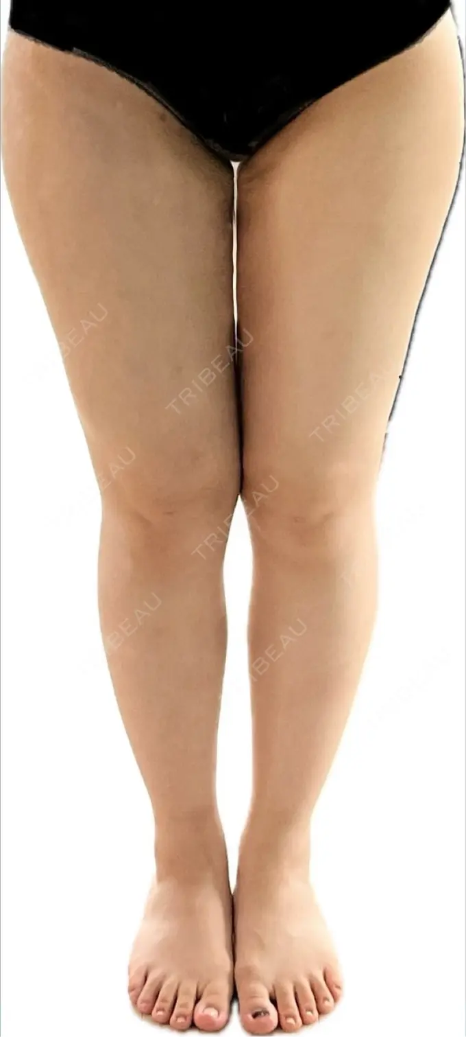 脂肪吸引（脚） Mods Clinic（モッズクリニック） 名古屋院 BEFORE メイン用