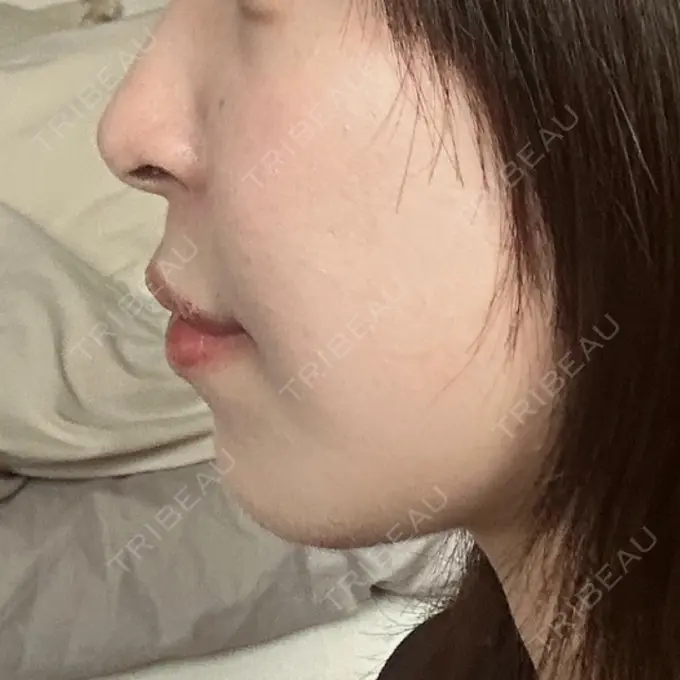 RF（高周波）たるみ治療 表参道メディカルクリニック 表参道院 BEFORE メイン用