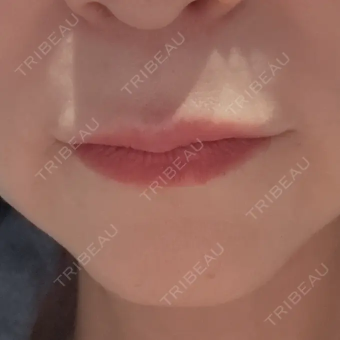 ヒアルロン酸注入（唇） / その他（輪郭） Code Beauty Clinic 名古屋院 BEFORE メイン用