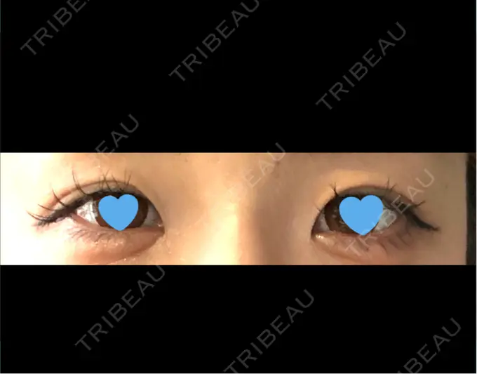 目頭切開 札幌ル・トロワ ビューティクリニックVogue BEFORE メイン用