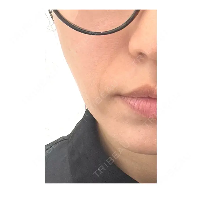 肌ヒアルロン酸注入（たるみ・シワ改善） / ボトックス（エラ・小顔） TCB東京中央美容外科 池袋駅前院 BEFORE メイン用