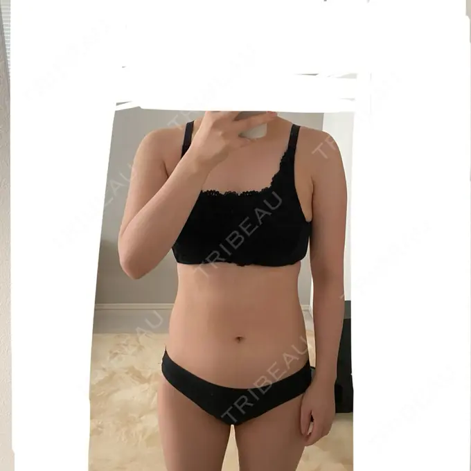 脂肪吸引（二の腕） / 脂肪吸引（腰） / 脂肪吸引（肩） / 医療脱毛（お腹） Mods Clinic（モッズクリニック） 大阪院 BEFORE メイン用