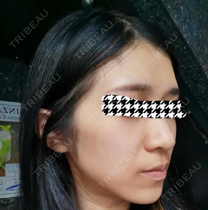 ピコレーザートーニング（美白・肝斑） 日比谷セントラルクリニック BEFORE メイン用