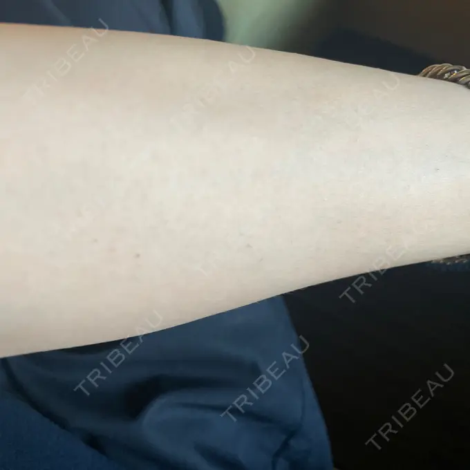 医療脱毛（腕） / 医療脱毛（お腹） / 医療脱毛（胸） 表参道メディカルクリニック 新宿院 BEFORE メイン用