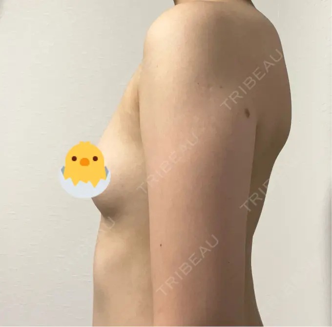 豊胸（脂肪注入） 湘南美容クリニック 新百合ヶ丘院 BEFORE メイン用