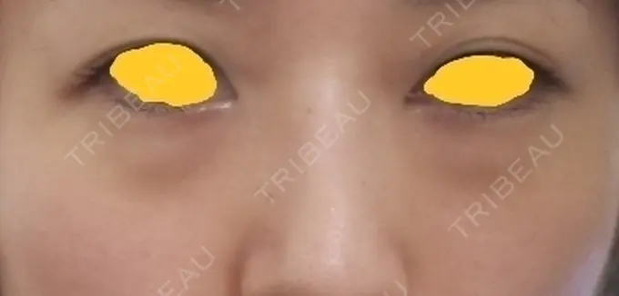 クマ治療 韓国ST美容整形外科 BEFORE メイン用