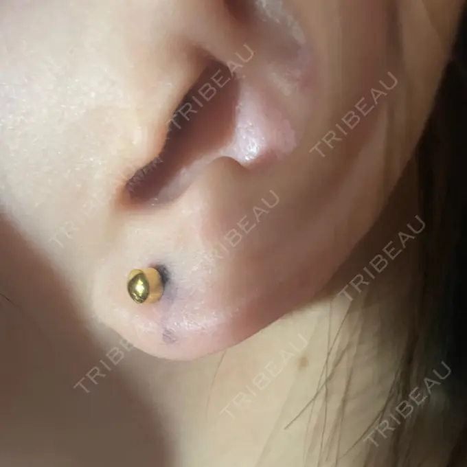 ピアス穴あけ 新宿ラクル美容外科クリニック 新宿院 BEFORE メイン用