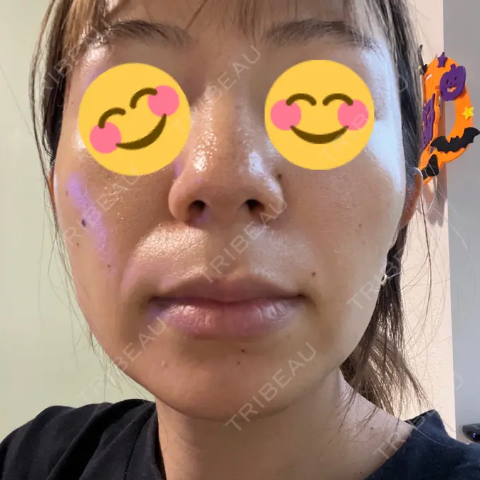 ピコレーザートーニング（美白・肝斑） / フラクショナルレーザー（毛穴・ニキビ跡） G MEDICAL ART クリニック 新宿院 BEFORE メイン用