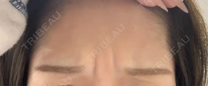 ボトックス（あご） / ボトックス（眉間） / ボトックス（額） ルラ美容クリニック 東京駅前院 BEFORE メイン用