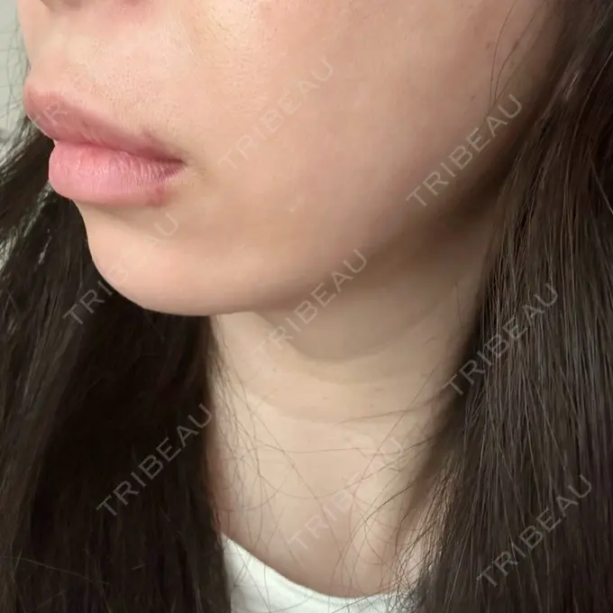 ヒアルロン酸注入（唇） / ボトックス（口角） / その他（鼻） ルラ美容クリニック 仙台院 / ルラスキンクリニック 仙台院 BEFORE メイン用