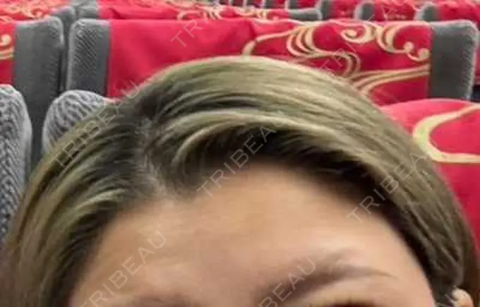 シワ取りボトックス 湘南美容クリニック 大阪四ツ橋院 BEFORE メイン用