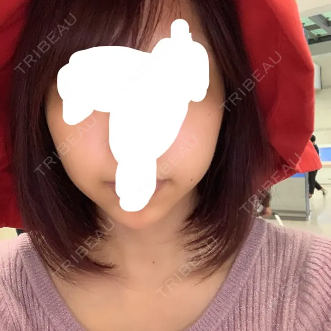 バッカルファット除去 / 脂肪吸引（顔） / ハイフ（顔） THE PLAN（ザ・プラン）美容整形外科・皮膚科 BEFORE メイン用