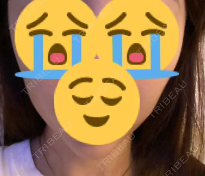 糸リフト / 脂肪吸引（顔） / 下まぶたの脂肪取り / 脂肪注入（目の下） 東京ココセランクリニック BEFORE メイン用