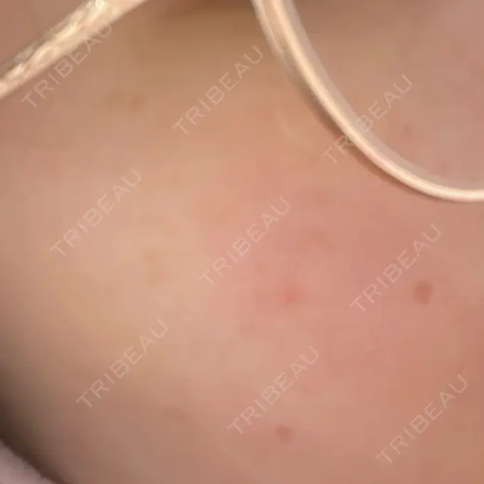 ピーリング（ニキビ・毛穴） / ルメッカ ルラ美容クリニック 神戸院 BEFORE メイン用