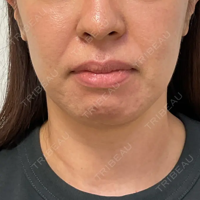 ボトックス（あご） / ボトックス（口角） / マイクロボトックス / ボトックス（眉間） / ボトックス（首） M'sクリニック【エムズクリニック】 BEFORE メイン用