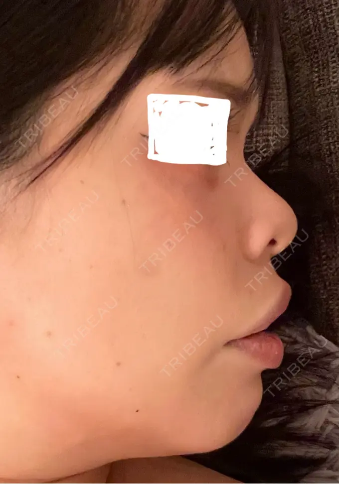 ヒアルロン酸注入（鼻） / ヒアルロン酸注入（あご） 新未来クリニック BEFORE メイン用