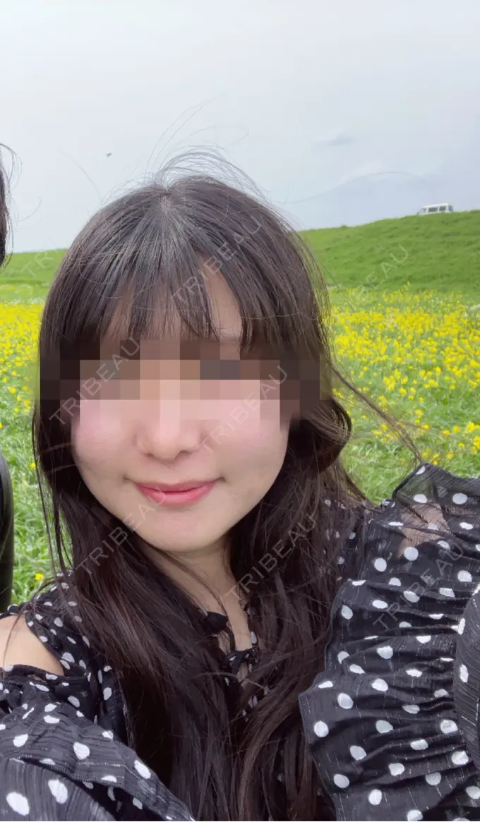 バッカルファット除去 / 脂肪吸引（顔） ルラ美容クリニック 大阪本院 BEFORE メイン用