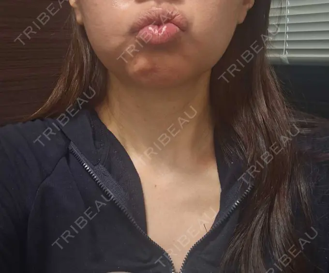 ボトックス（あご） / ボトックス（エラ・小顔） / ボトックス（額） もとび美容外科クリニック 新宿院 BEFORE メイン用