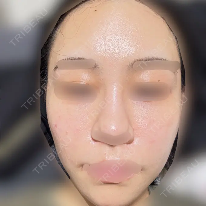 ピコレーザートーニング（美白・肝斑） 美容皮膚科エルムクリニック 大阪院 BEFORE メイン用