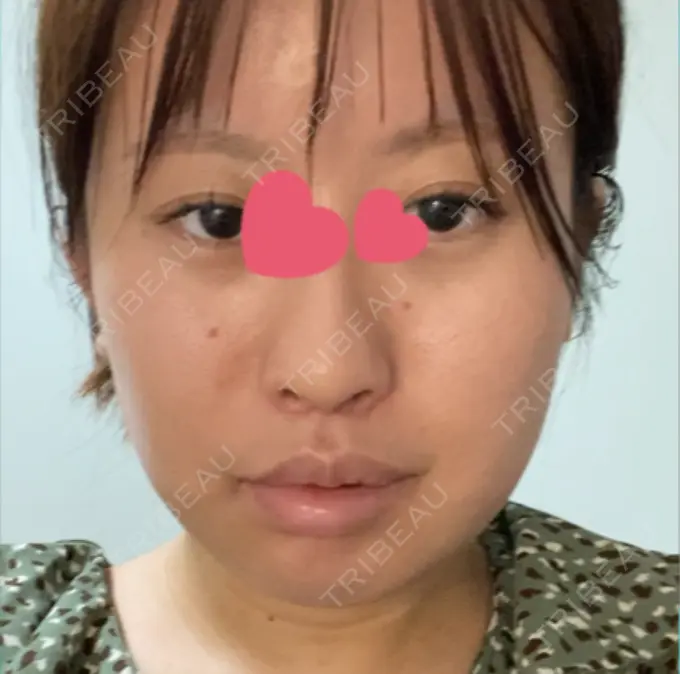 眼瞼下垂（非切開） / ピアス穴あけ / ニキビ治療 しむら皮膚科クリニック BEFORE メイン用