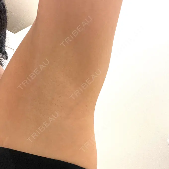 ワキ汗治療（ボトックス） DMTC美容皮膚科 大宮院 BEFORE メイン用