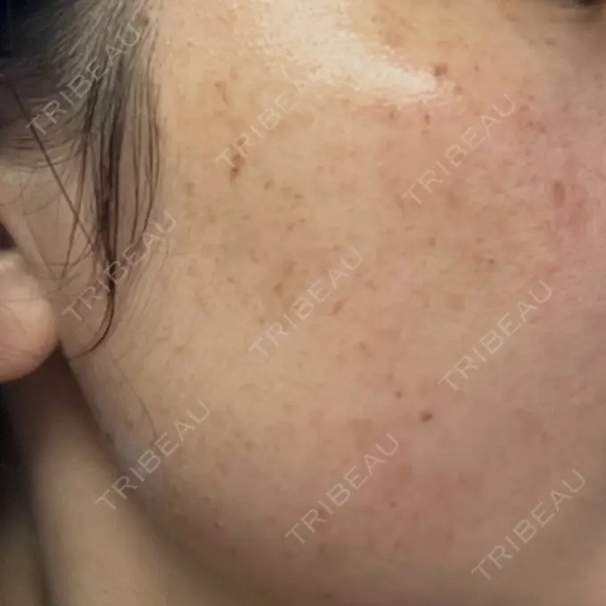 ルメッカ ルラ美容クリニック 広島院 BEFORE メイン用