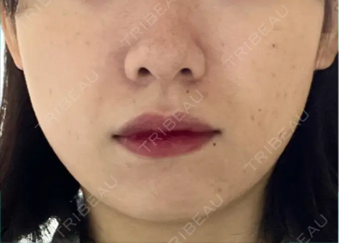 ヒアルロン酸注入（あご） / ボトックス（エラ・小顔） / ヒアルロン酸注入（唇） 日比谷セントラルクリニック BEFORE メイン用