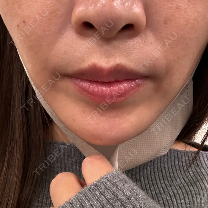 医療脱毛（顔） 共立美容外科 熊本院 BEFORE メイン用