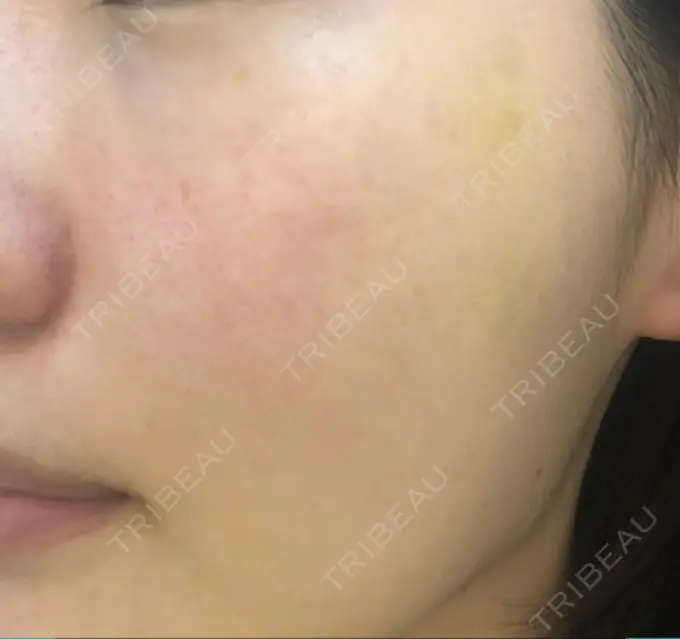 再生医療 プムクリニック新論峴店 BEFORE メイン用