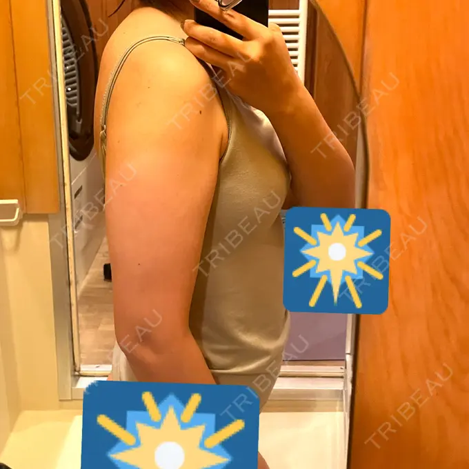 脂肪吸引（二の腕） / 脂肪吸引（肩） 湘南美容クリニック 大阪梅田本院 BEFORE メイン用