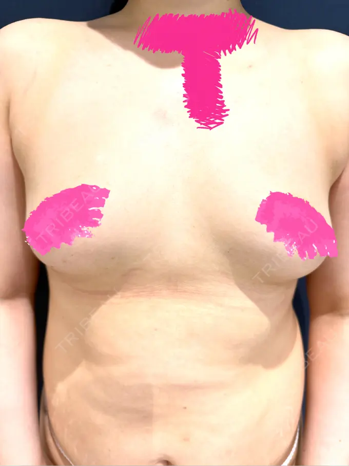 脂肪吸引（二の腕） / 脂肪吸引（お腹） / 豊胸（脂肪注入） / 脂肪注入（額） / 脂肪吸引（腰） ICON CLINIC BEFORE メイン用