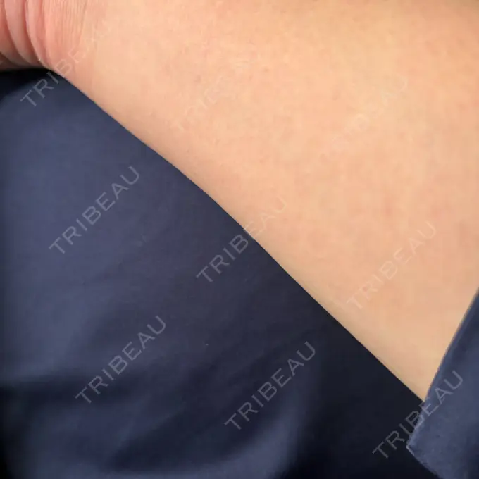 医療脱毛（全身） ルラ美容クリニック 神戸院 BEFORE メイン用