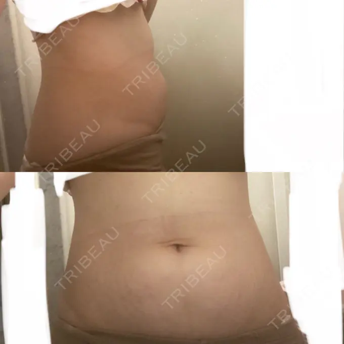 脂肪吸引（顔） / 脂肪吸引（二の腕） / 医療痩身（お腹） / 脂肪吸引（腰） / 脂肪吸引（肩） Mods Clinic（モッズクリニック） 福岡院 BEFORE メイン用