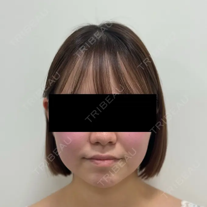 脂肪吸引（顔） / 脂肪吸引注射（顔） SEA CLINIC（シークリニック） BEFORE メイン用