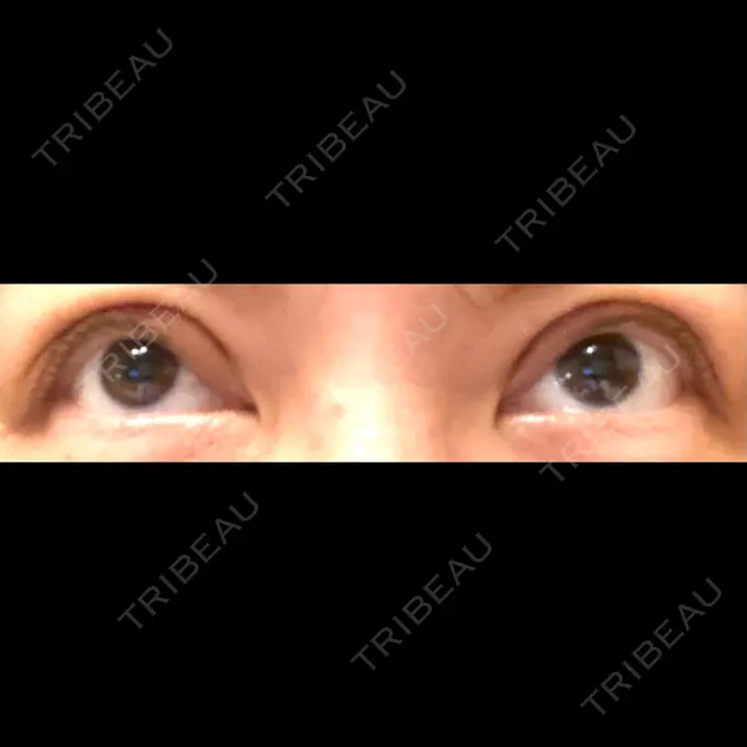 二重埋没 TCB東京中央美容外科 仙台広瀬通院 BEFORE メイン用