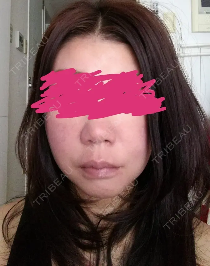 糸リフト 有楽町高野美容クリニック BEFORE メイン用