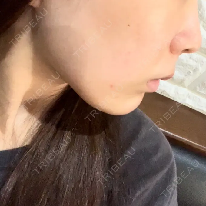 RF（高周波）たるみ治療 表参道メディカルクリニック 表参道院 BEFORE メイン用