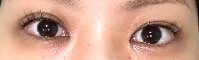 目尻切開 / タレ目形成・グラマラスライン（埋没） LOUIS CLINIC 二子玉川院【ルイクリニック】 BEFORE メイン用